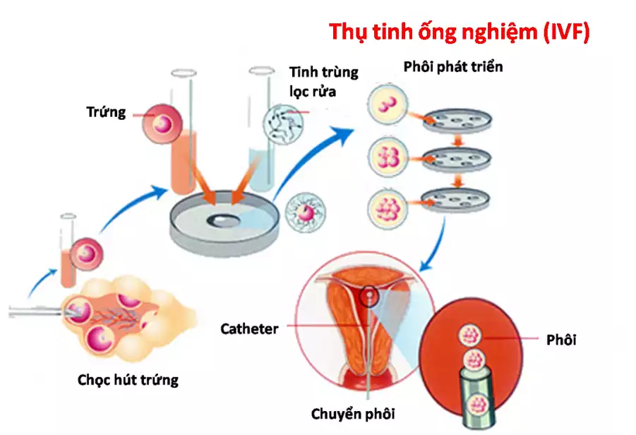3 Lưu Ý Quan Trọng Trong Quy Trình Làm IVF