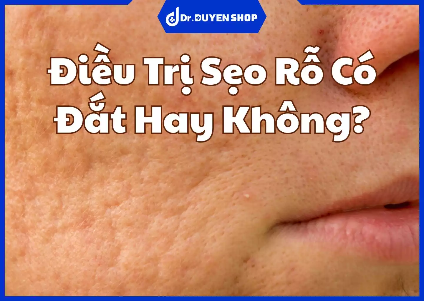 Điều Trị Sẹo Rỗ Có Đắt Hay Không? Phương Pháp Nào Tốt