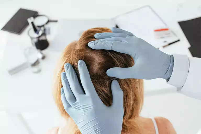 Phân biệt gàu và vẩy nến da đầu: Cách nhận biết chính xác