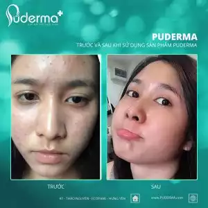 Tế bào gốc Puderma BIO-S đỏ