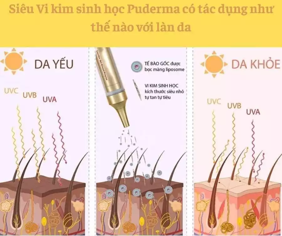 HIỂU RÕ HƠN VỀ TÁC DỤNG VƯỢT TRỘI CỦA VI KIM SINH HỌC PUDERMA