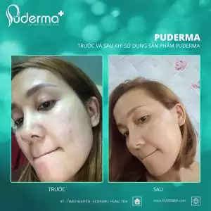 Tế bào gốc Puderma BIO-S đỏ