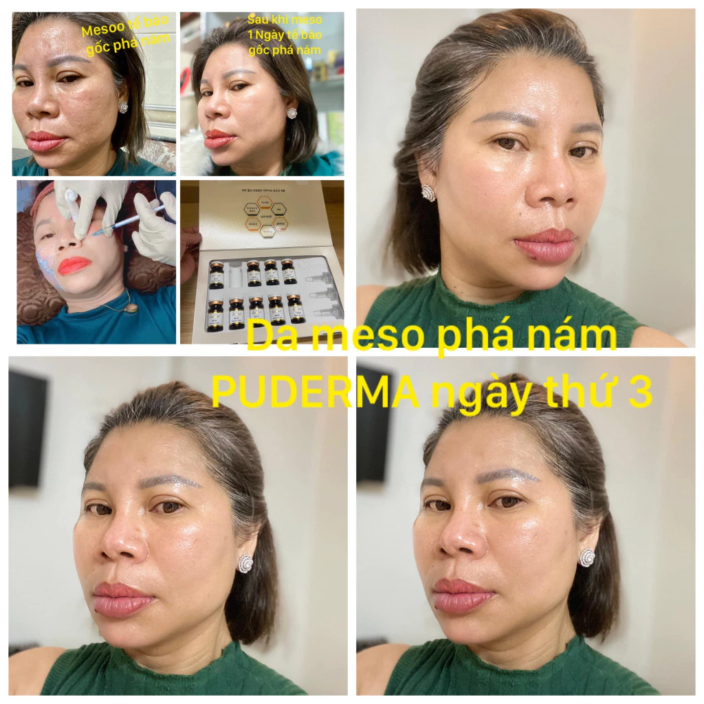 Tế bào gốc nám Bio-W tan triệt nám tận gốc - thần tốc - an toàn mang lại làn da trắng sáng, mịn màng_thumbnail_3