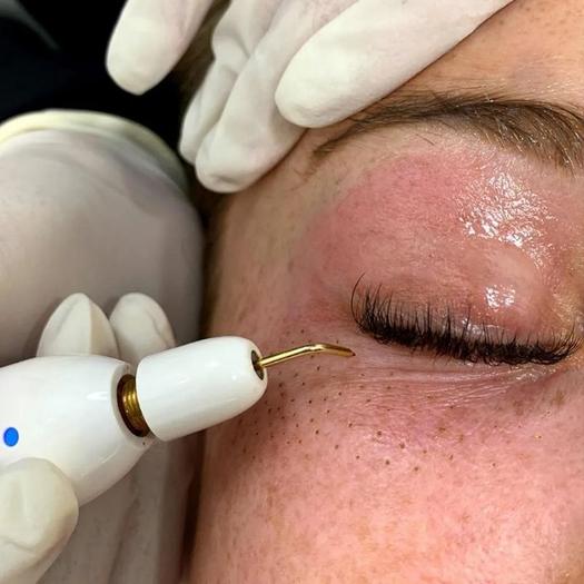 Product image - Plasma Fibroblast Therapy