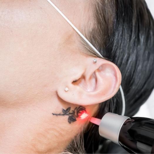 Product image - Éclat au Laser (Laser & Light Therapy) Tattoo removal