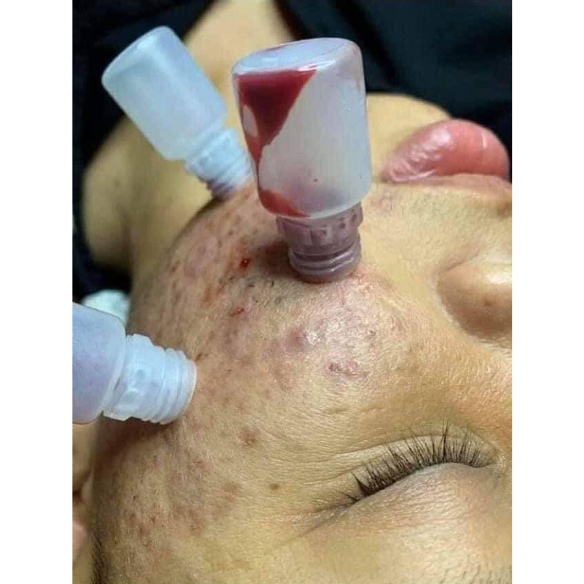 Ống nhựa hút mụn viêm mụn mủ máu bầm 5ml Dầy_thumbnail_4