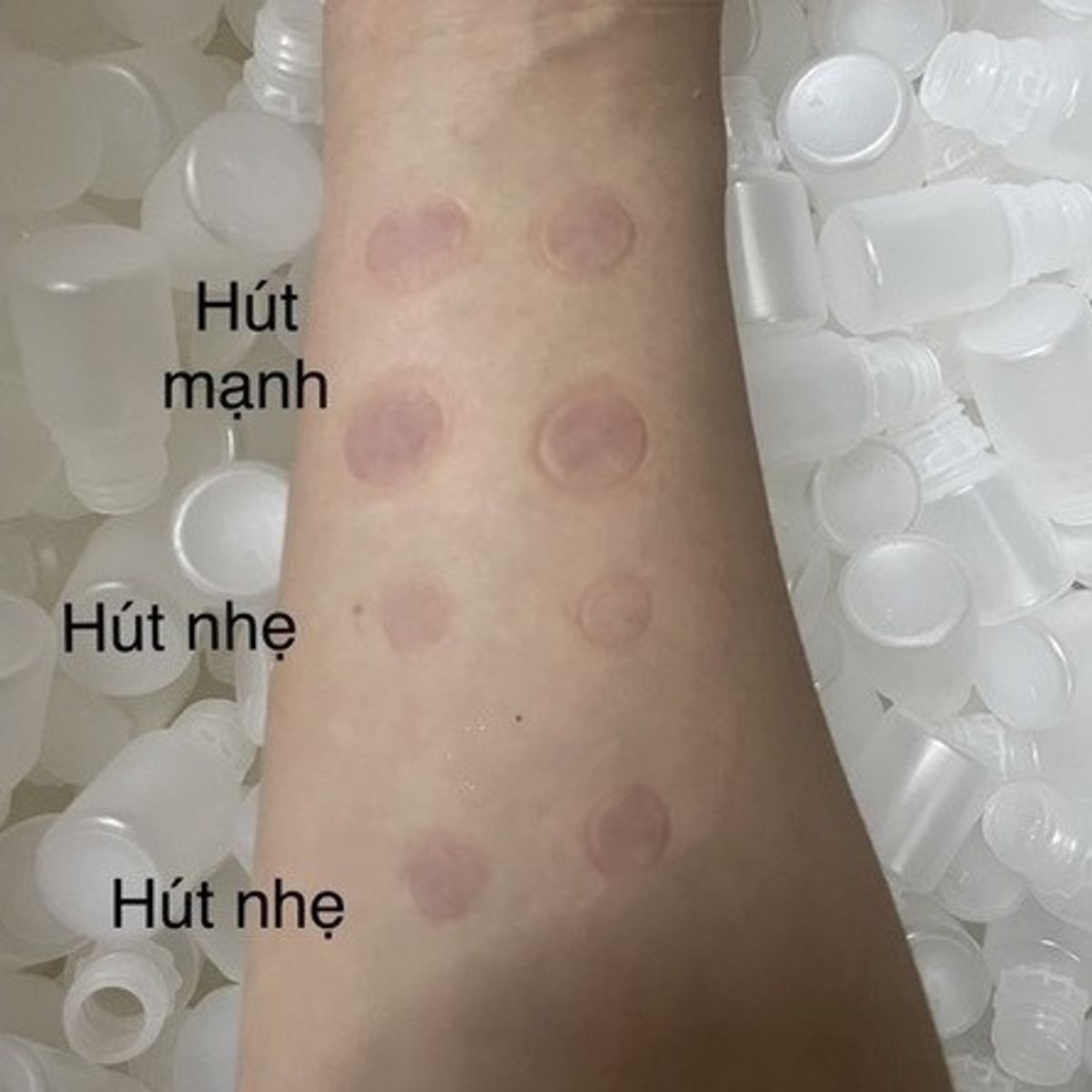 Ống nhựa hút mụn viêm mụn mủ máu bầm 5ml Dầy_thumbnail_6