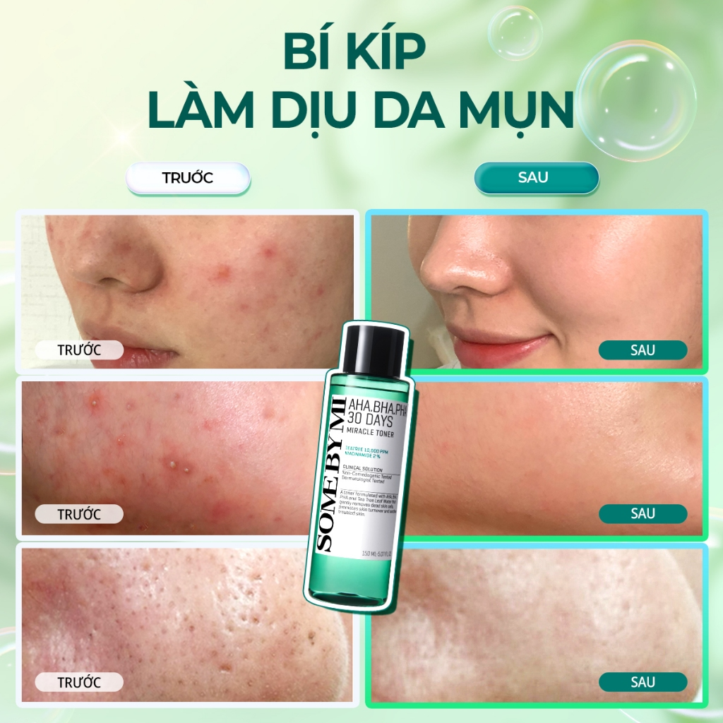 [SOME BY MI] Toner cho da dầu mụn Some By Mi AHA-BHA-PHA 30 Days Miracle 150ml_thumbnail_2