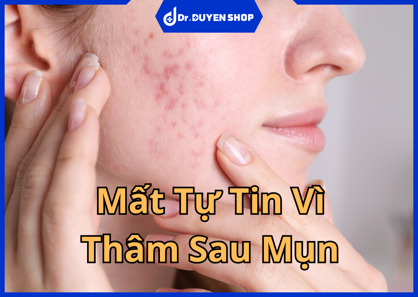 Hết Mụn Nhưng Vẫn Mất Tự Tin Vì Thâm Sau Mụn