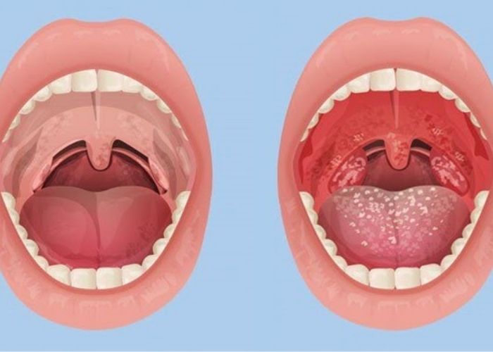 Viêm Họng Hạt Là Gì? Nguyên Nhân, Triệu Chứng Và Cách Điều Trị Hiệu Quả