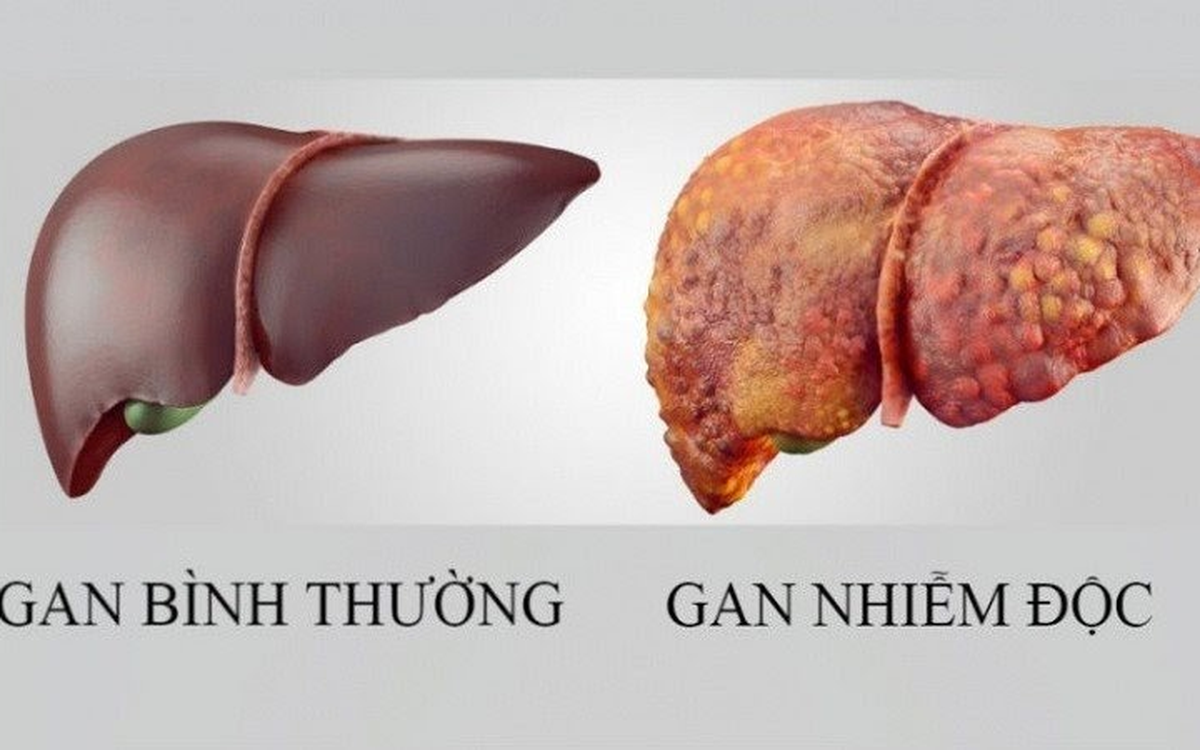 Giải Độc Gan