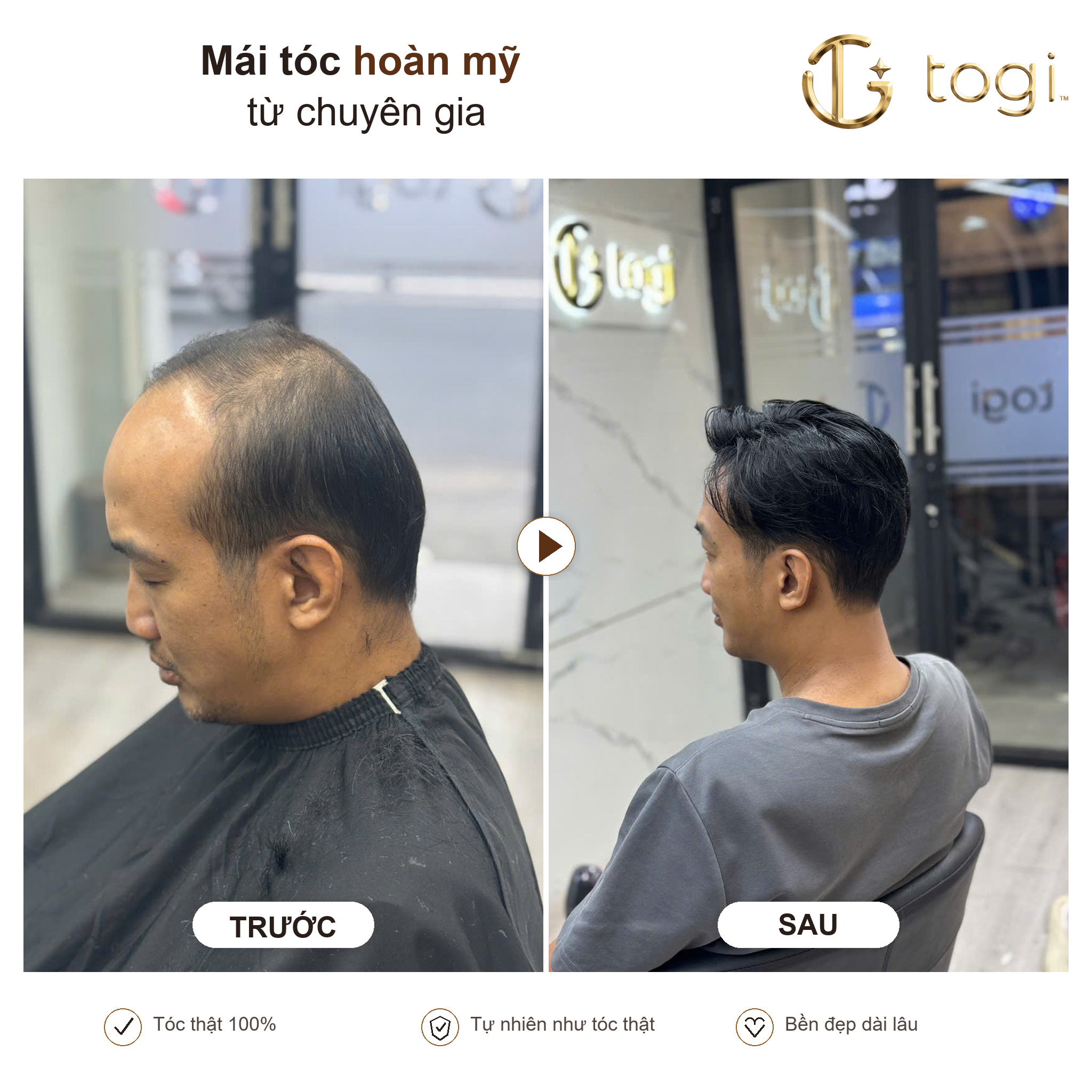 Togi65 góc nghiêng đường trán tự nhiên