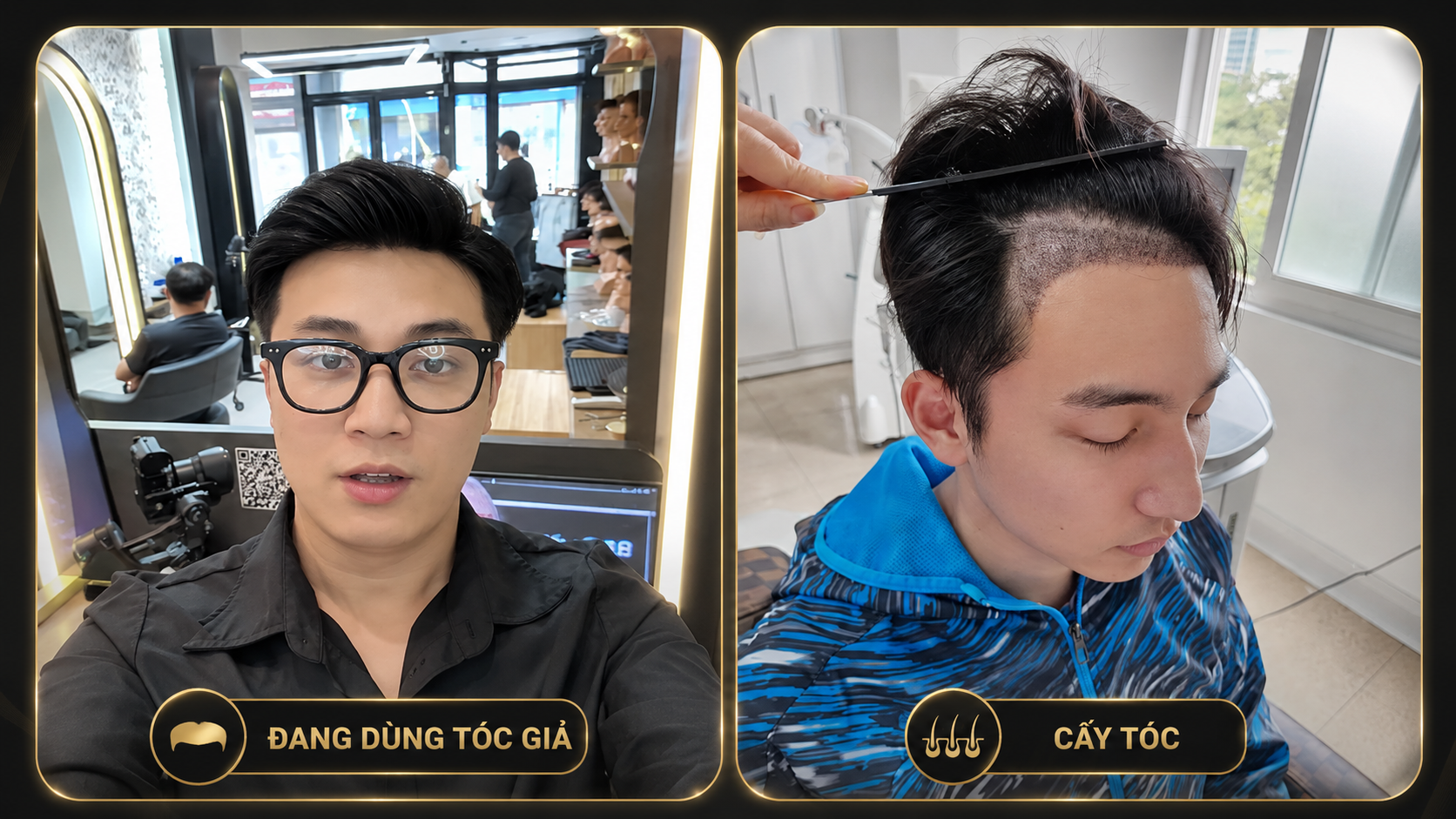 Tóc Giả Nam Che Hói: Giải Pháp Nhanh, An Toàn Hơn Cấy Tóc?