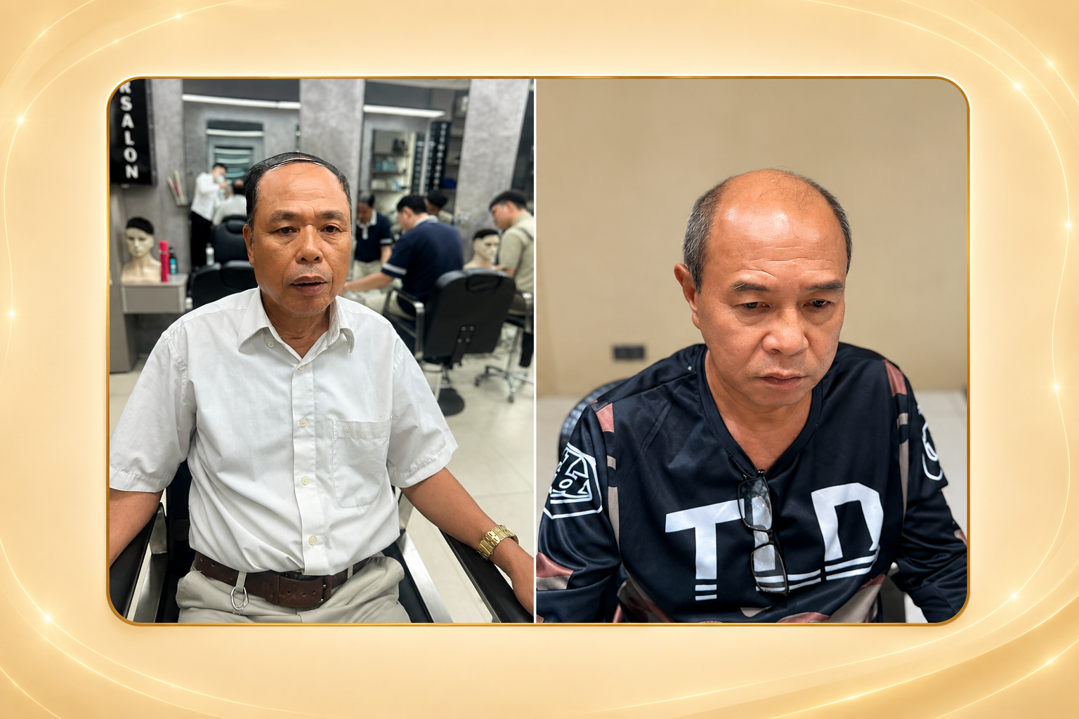 Rụng tóc nam tuổi 40: Nguyên nhân và giải pháp phù hợp