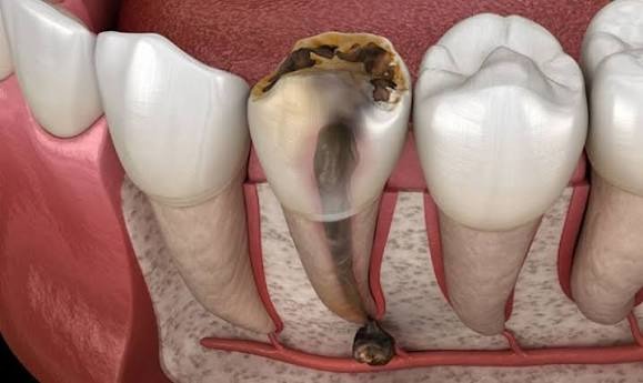 Nhức răng không rõ nguyên nhân: 10 nguyên nhân thường gặp và cách xử lý