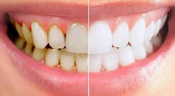 Cao răng là gì? Nguyên nhân, tác hại và cách phòng ngừa hiệu quả