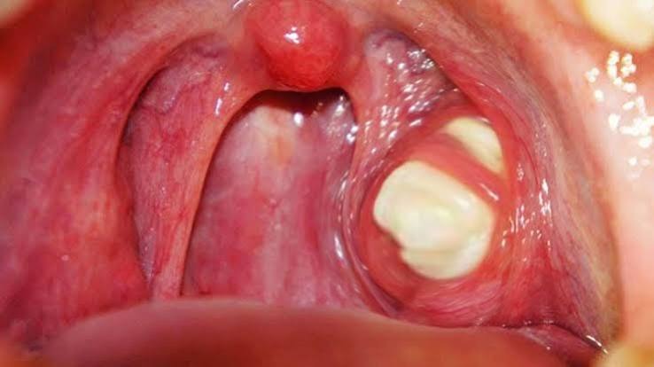 Sỏi amidan là gì? Nguyên nhân, triệu chứng và cách xử lý an toàn