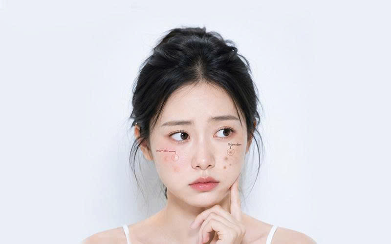 Phân biệt thâm đỏ (PIE) và thâm đen (PIH)