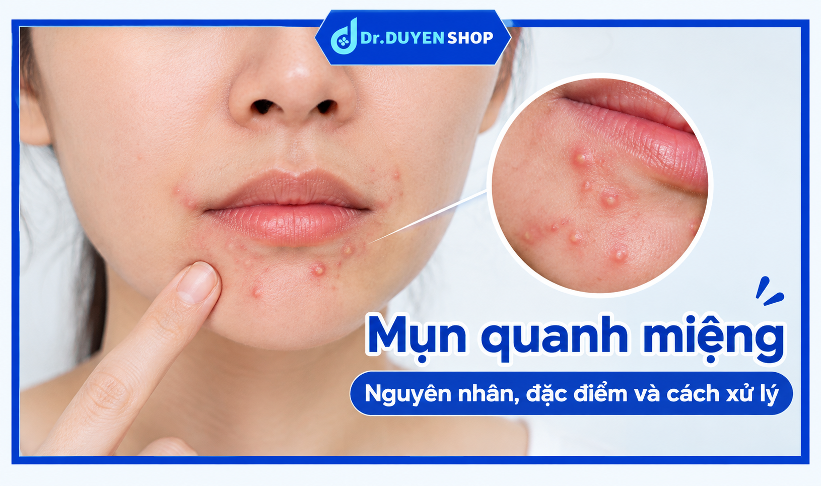 Mụn Quanh Miệng: Nguyên Nhân, Cách Chăm Sóc Và Cách Xử Lý