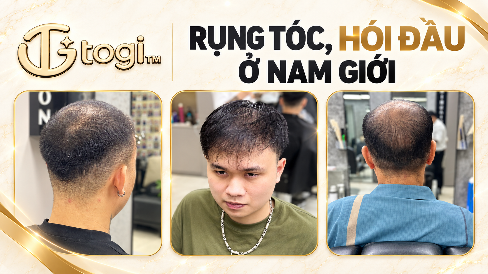 Trán Cao Hói Đỉnh Nên Để Tóc Gì? Case Tóc Giả Nửa Đầu