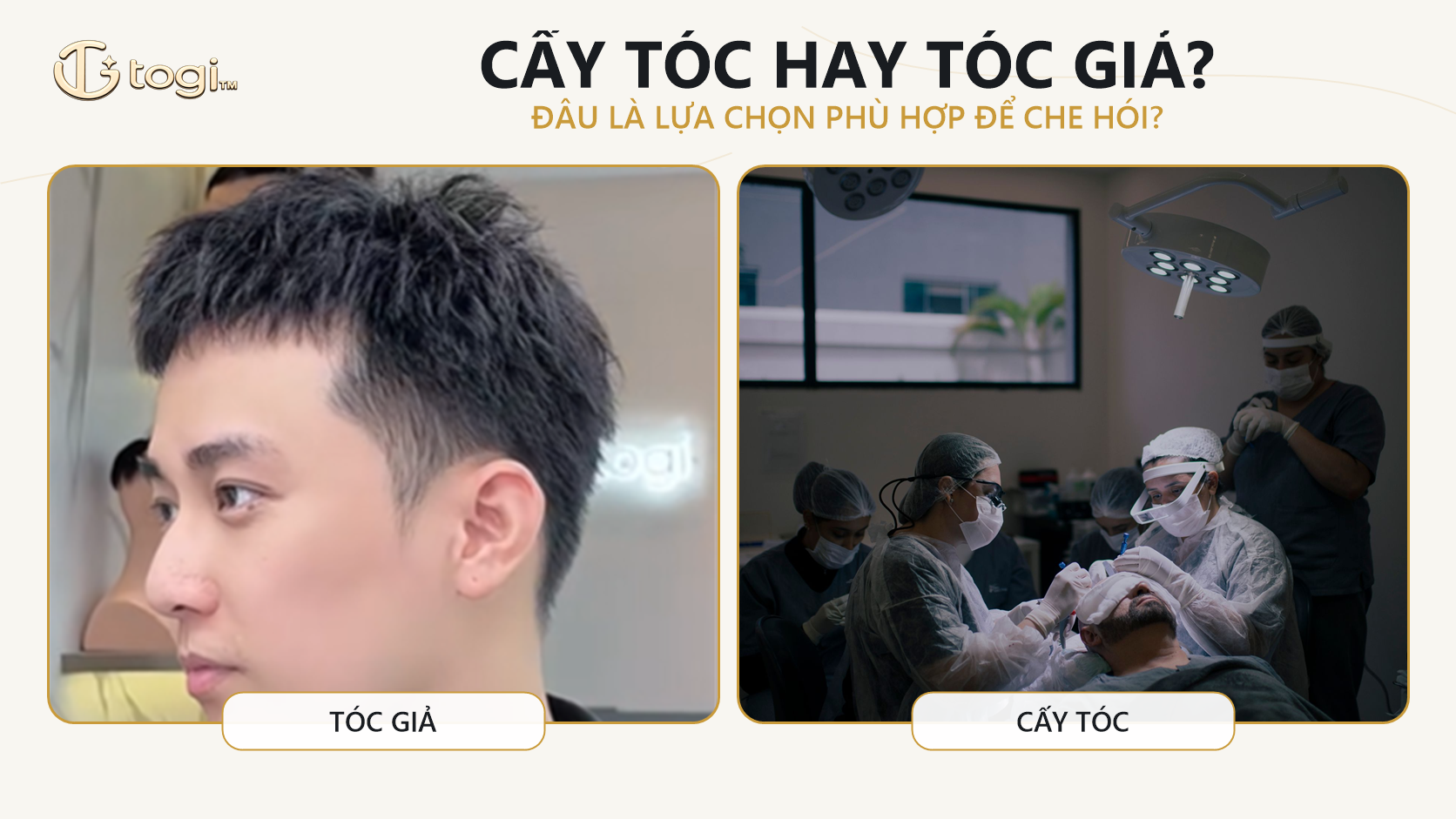 Tóc giả nam che hói hay cấy tóc?