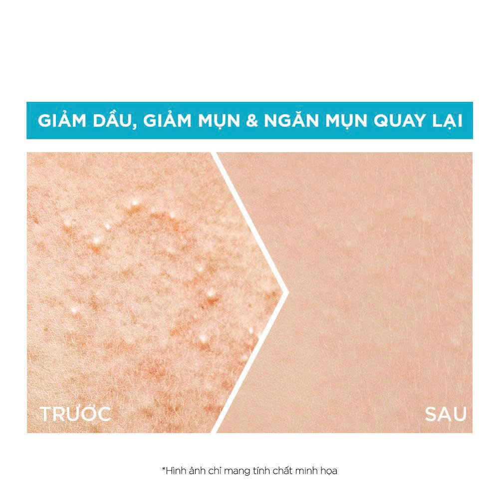Serum Garnier Giảm Mụn – Mờ Thâm Cho Da Dầu, Da Mụn – 30ml_thumbnail_2