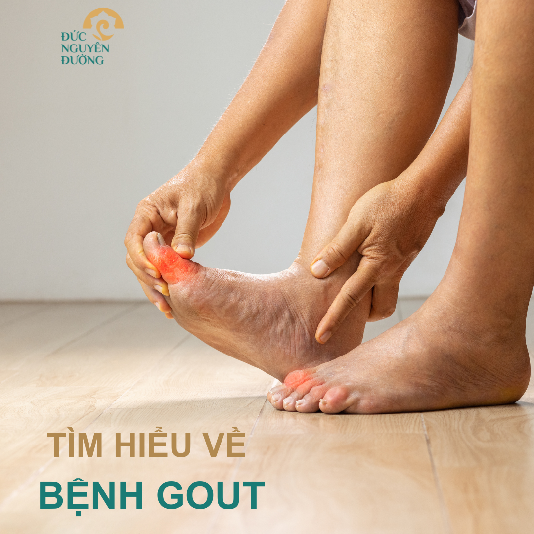 Tìm hiểu về bệnh GOUT