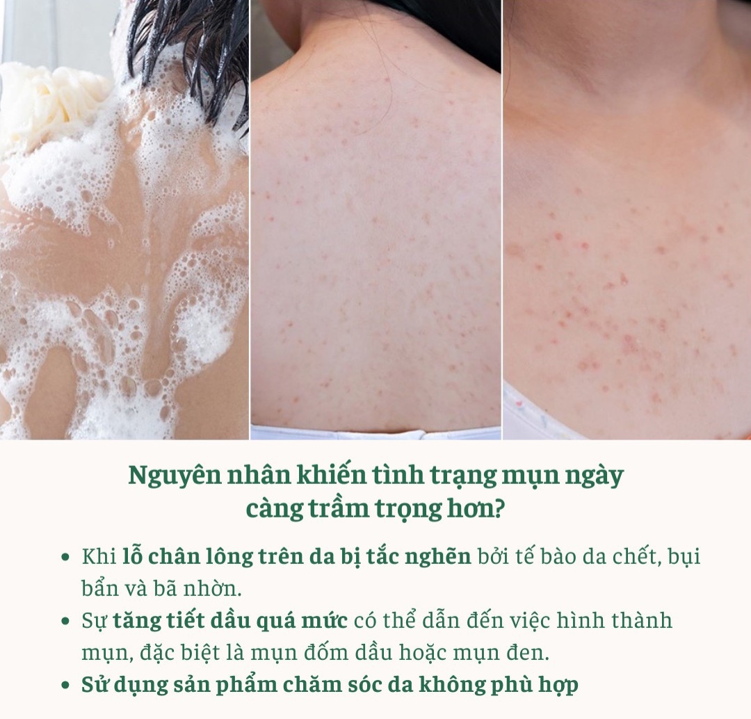 HEALSEED ACNE AQUA BODY WASH - Sữa Tắm Giảm Mụn Cơ Thể & Làm Sạch Sâu – Salicylic Acid & 7HA – 300ml - [HS008]_thumbnail_6