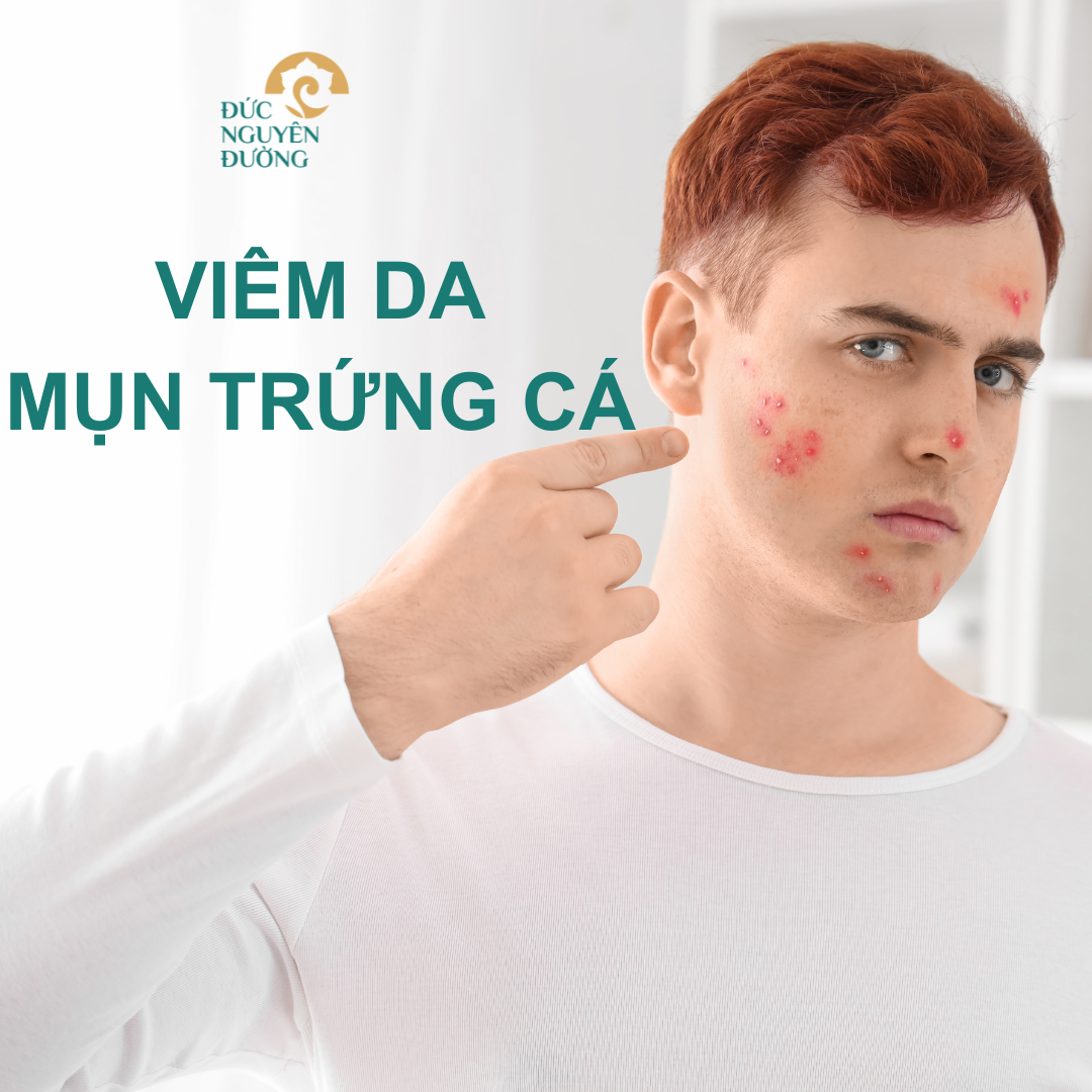 Viêm da, mụn trứng cá