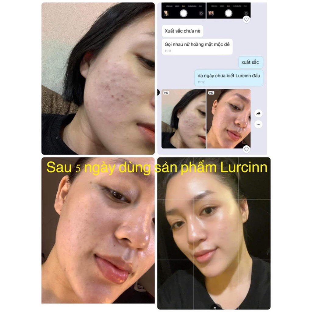 Serum Chăm Sóc Da Mụn Mờ Thâm LURCINN SAPANZI Prevent Acne 10ml_thumbnail_9
