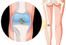 Phình phồng đĩa đệm – Nguyên nhân, triệu chứng và cách điều trị hiện đại
