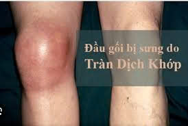 Tràn Dịch Khớp Gối – Nguyên nhân, triệu chứng và cách điều trị hiện đại