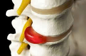 Vôi hóa cột sống – Nguyên nhân, triệu chứng và phương pháp điều trị hiệu quả