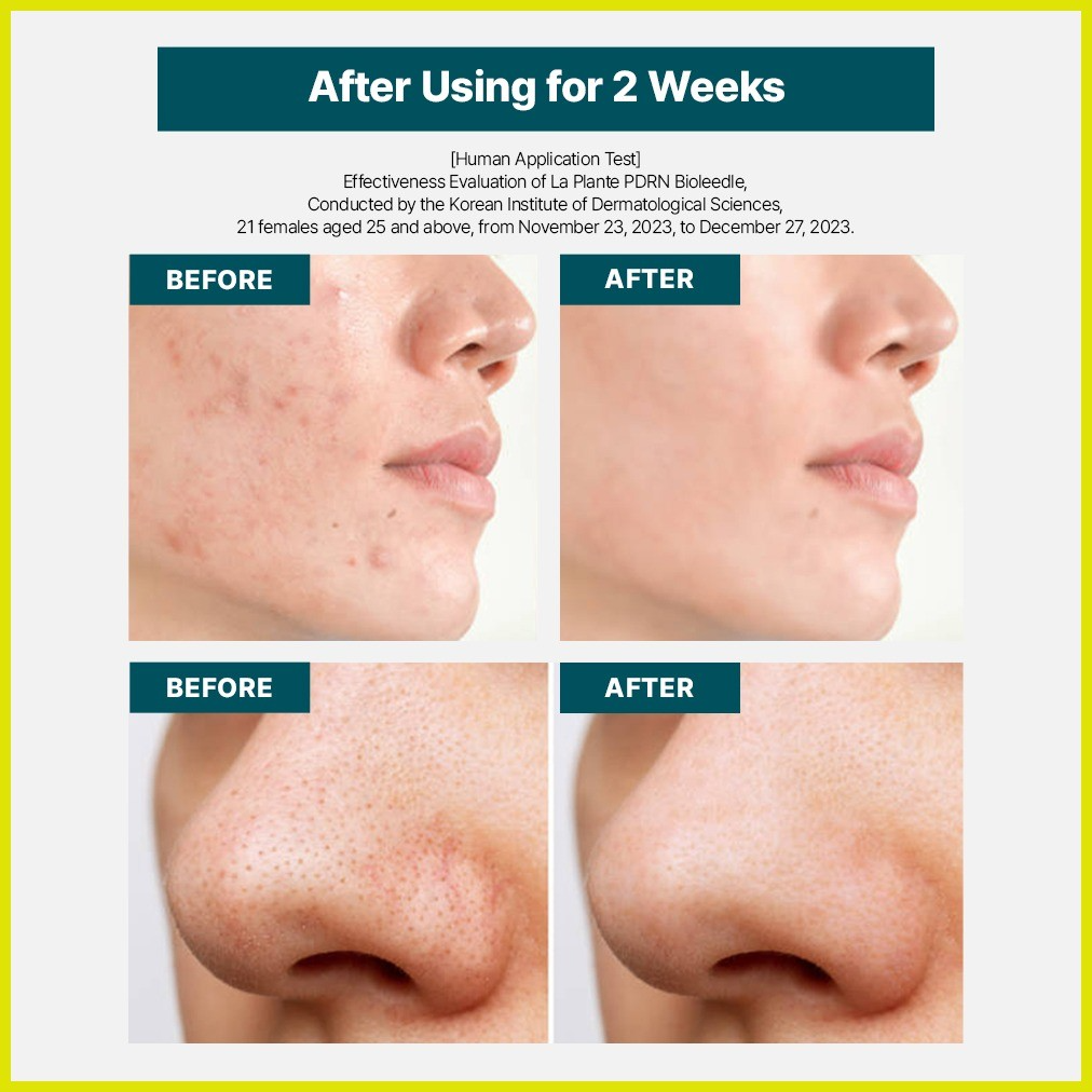 La Plante PDRN Bioleedle 100_thumbnail_2
