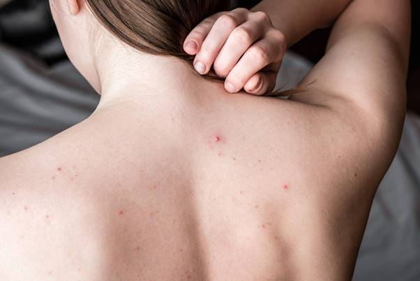 Mụn lưng: Nguyên nhân, dấu hiệu và giải pháp điều trị