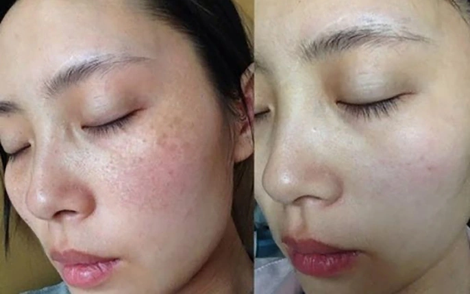 Tôi đang sử dụng combo và điều trị rất hiệu quả, cảm ơn MOCHA VIỆT NAm_0