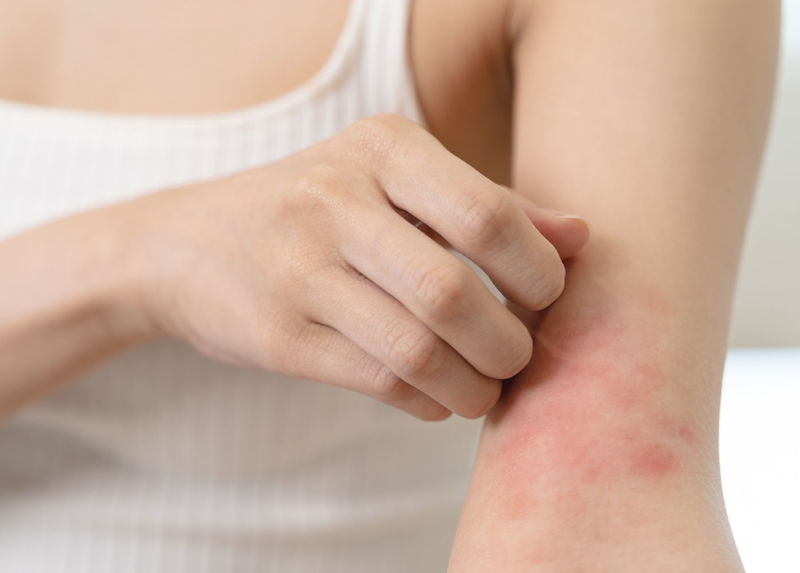 MẨN NGỨA MỀ ĐAY, TẮM NGAY LÁ NÀY