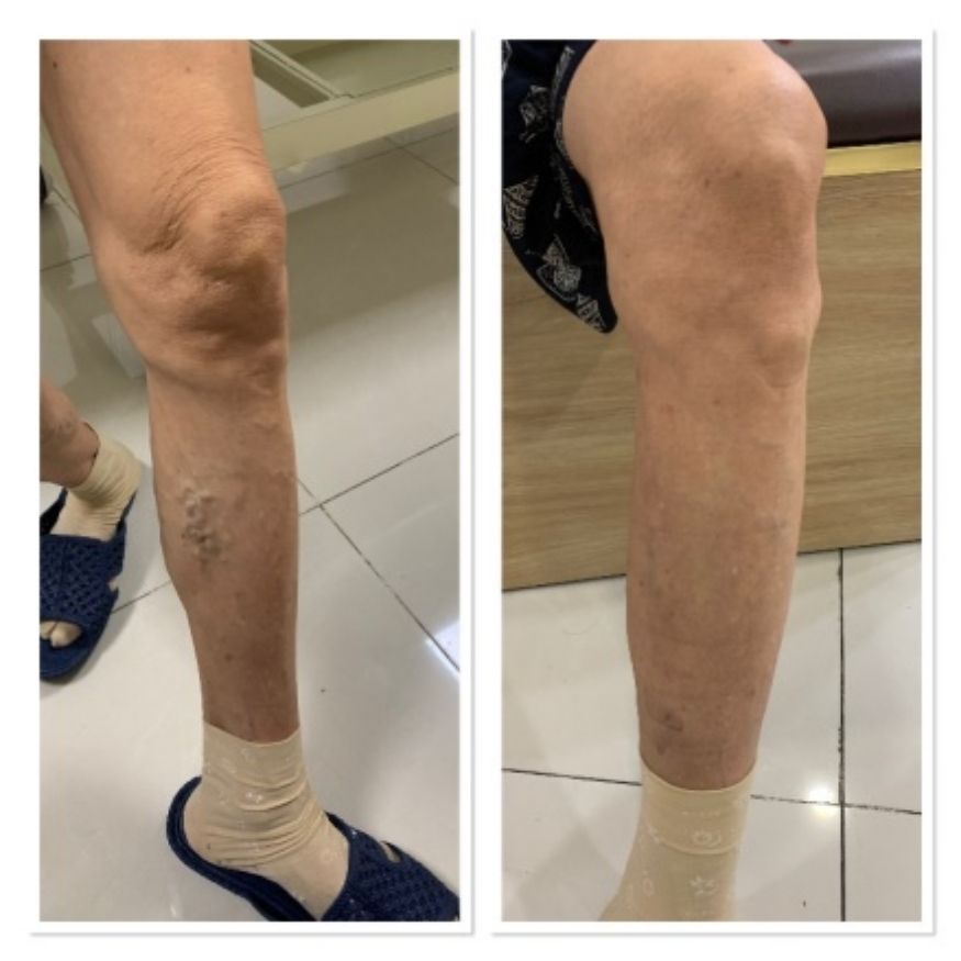 Máy nén ép trị liệu suy giãn tĩnh mạch chân Kachi MK394_thumbnail_18