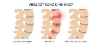 Viêm Cột Sống Dính Khớp – Nguyên nhân, triệu chứng và cách điều trị hiện đại