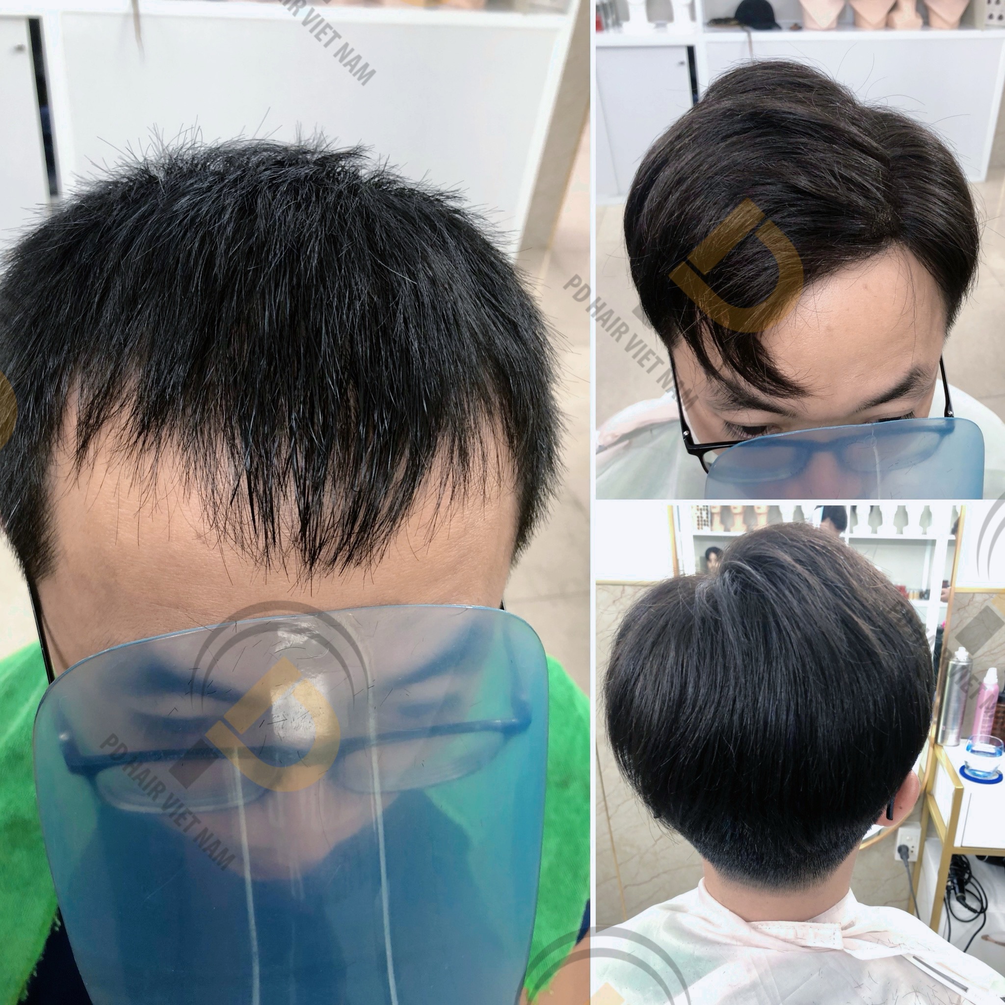 Tóc giả che trán chữ M: Giải pháp hoàn hảo cho mọi quý ông