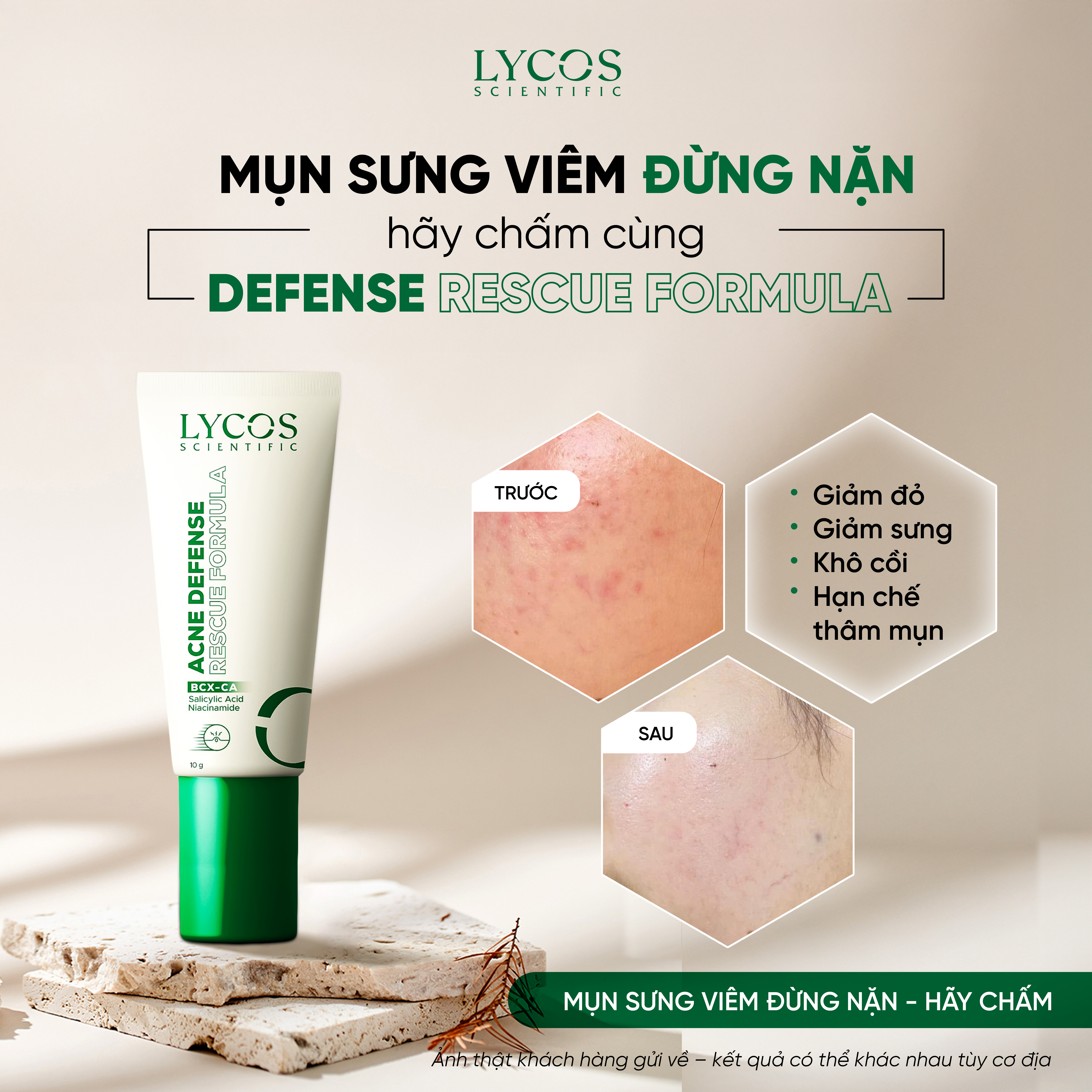 Kem Chấm Mụn LYCOS Acne Defense Rescue Formula Hỗ Trợ Làm Khô Cồi, Làm Dịu Và Chăm Sóc Vùng Da Mụn10g_thumbnail_23