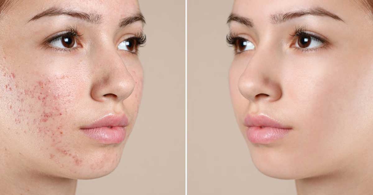 TOP 10 các thành phần, hoạt chất trị thâm mụn hiệu quả nhất