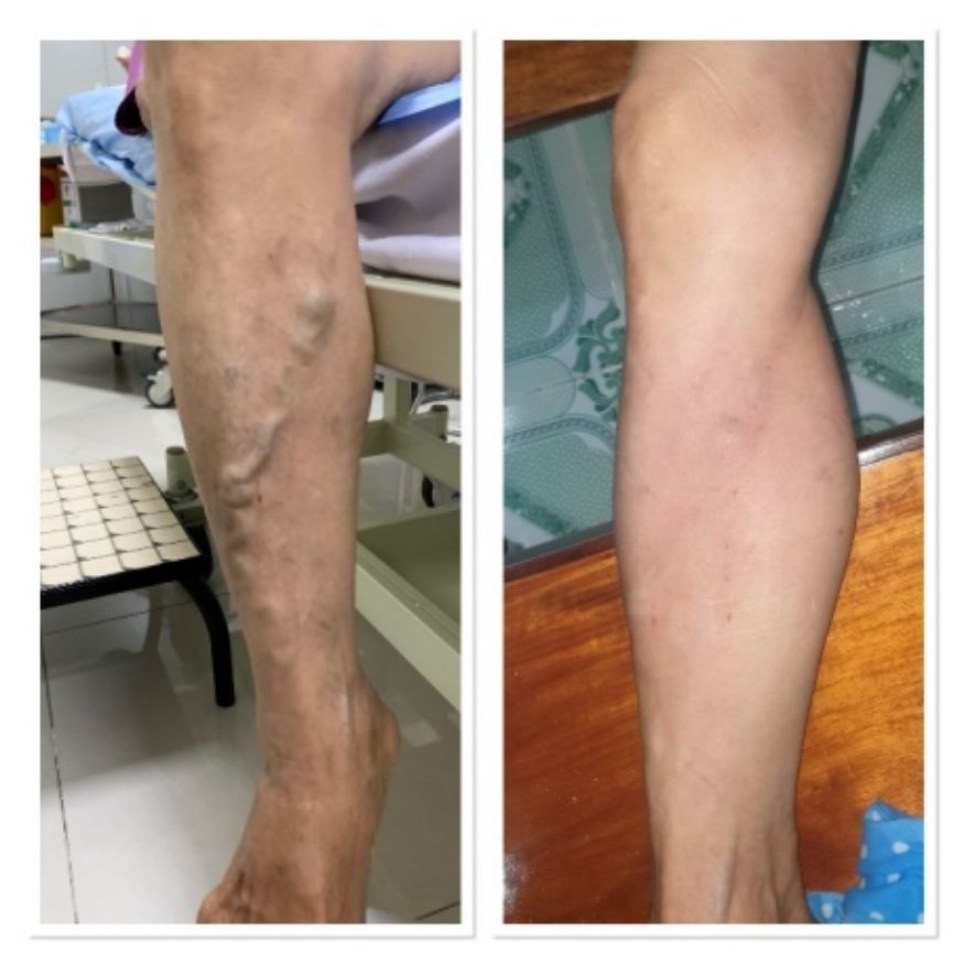 Máy nén ép trị liệu suy giãn tĩnh mạch chân Kachi MK394_thumbnail_19