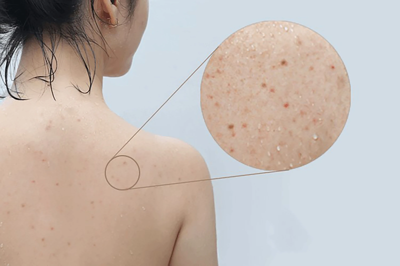 Mụn lưng có tự hết không? Sự thật cần biết