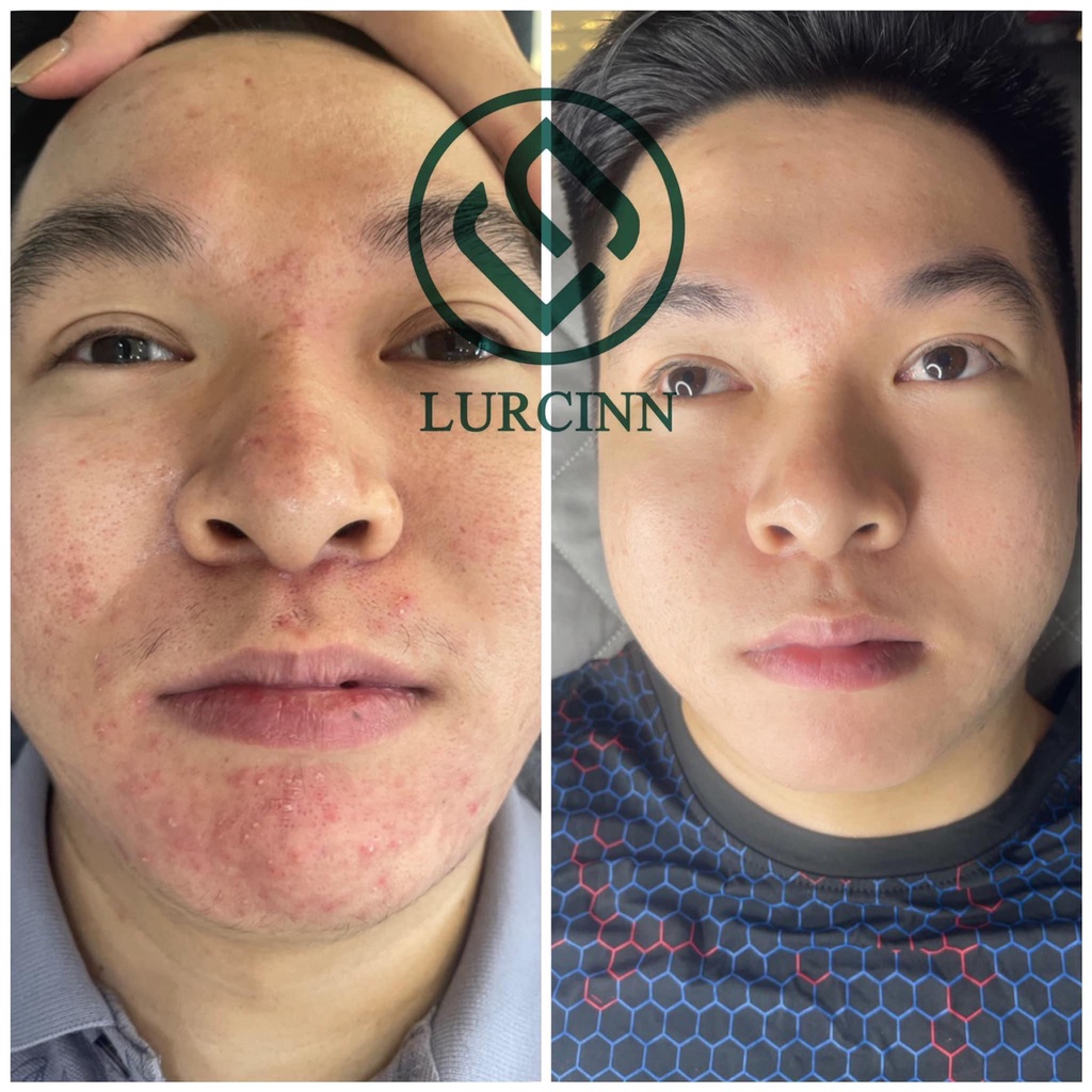 Serum mụn Lurcinn Detox Acne 10ml_thumbnail_8