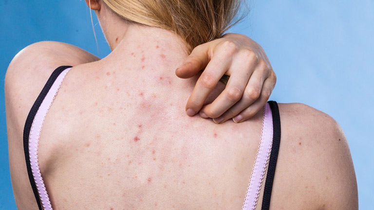 Cách trị viêm nang lông ở lưng tại nhà hiệu quả nhất