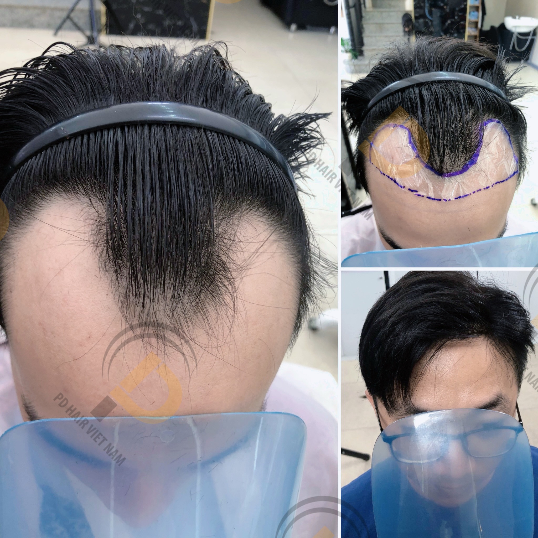 Tóc Giả Nam Chữ M: Bí Quyết Tự Tin Cho Nam Giới Hói Trán