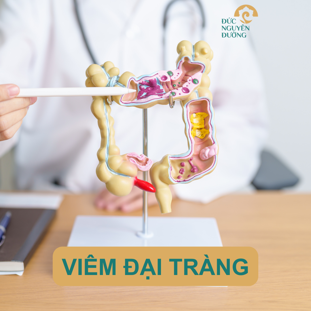 Viêm đại tràng