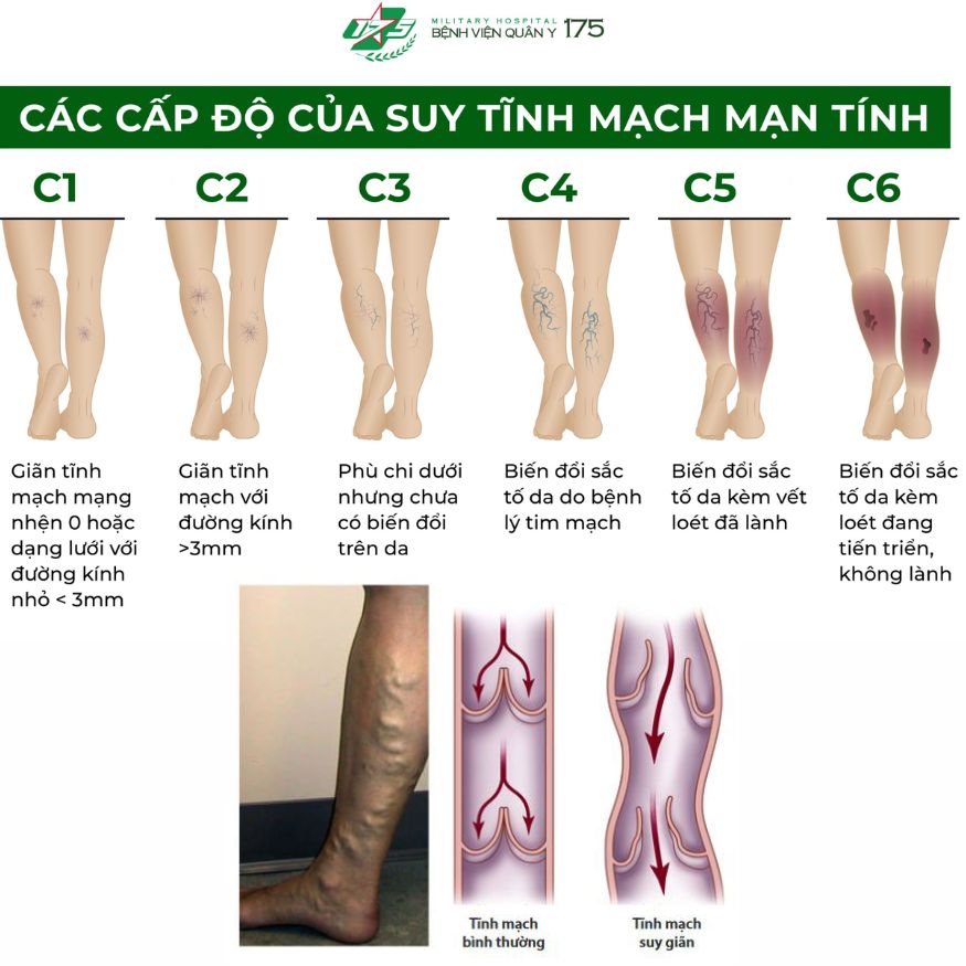 Máy nén ép trị liệu suy giãn tĩnh mạch chân Kachi MK394_thumbnail_5