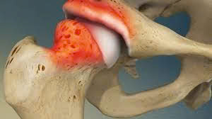 Viêm khớp háng – Cơn đau âm ỉ khiến bạn khó khăn trong từng bước đi